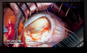MediAVentures First 4K Live Cardiac Surgery